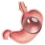 Baloni Gastrik Procedura e Balonit gastrik eshte nje zgjidhje jo kirurgjikale
