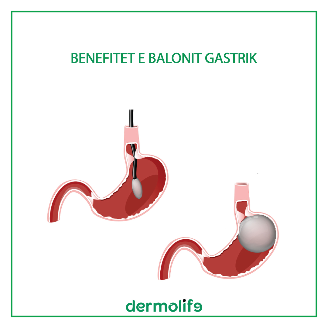 5 Benefitet e Balonit Gastrik