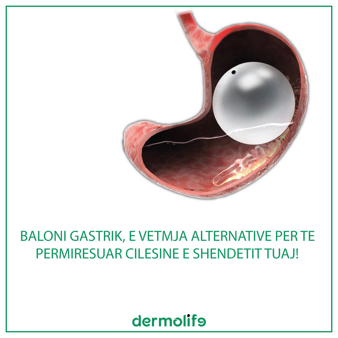 Baloni gastrik, e vetmja alternative per te permiresuar cilesine e shendetit tuaj!