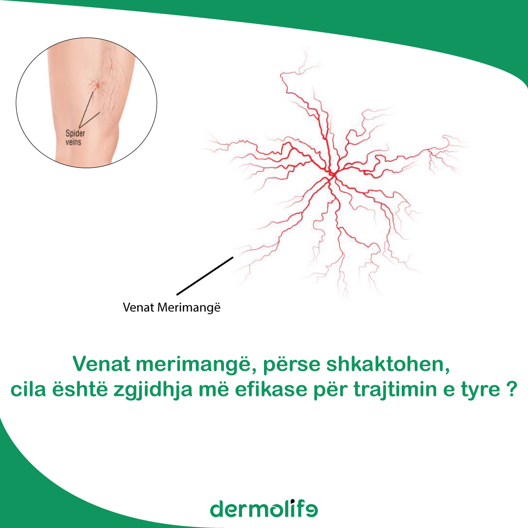 enat merimange, perse shkaktohen, cila eshte zgjidhja me efikase per trajtimin e tyre