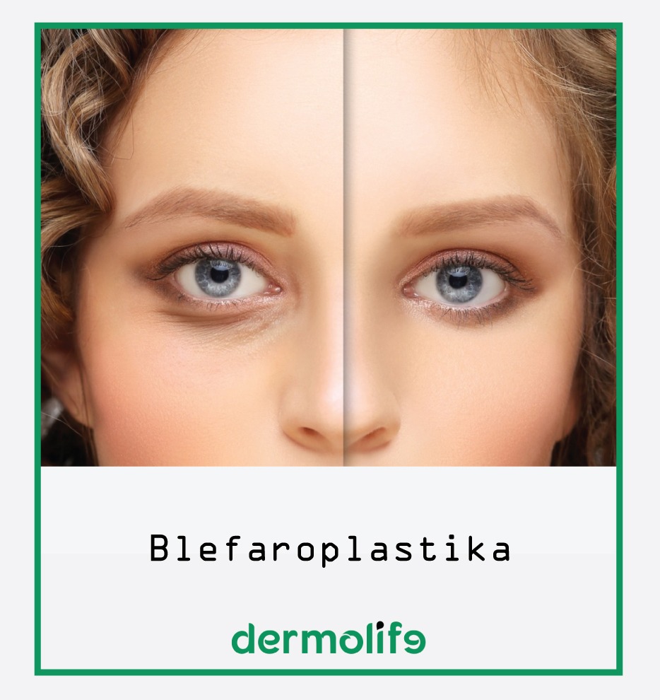 Cfare eshte blefaroplastika