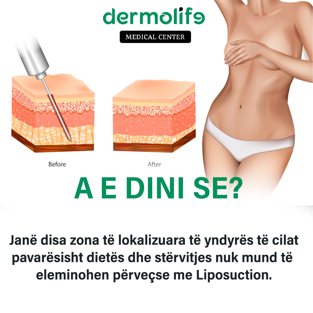 Benefitet e Liposuction