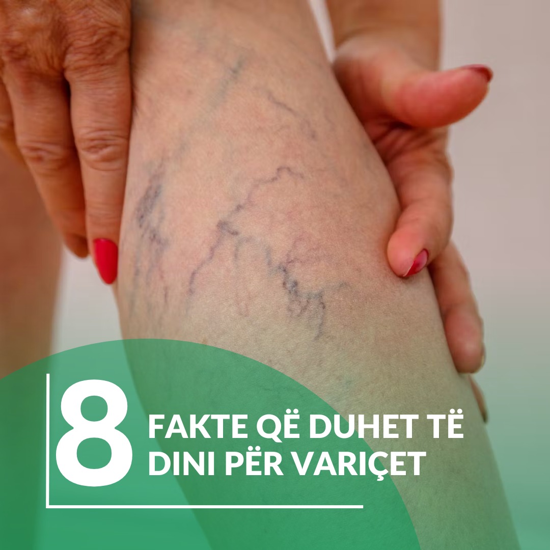 8-fakte-varice