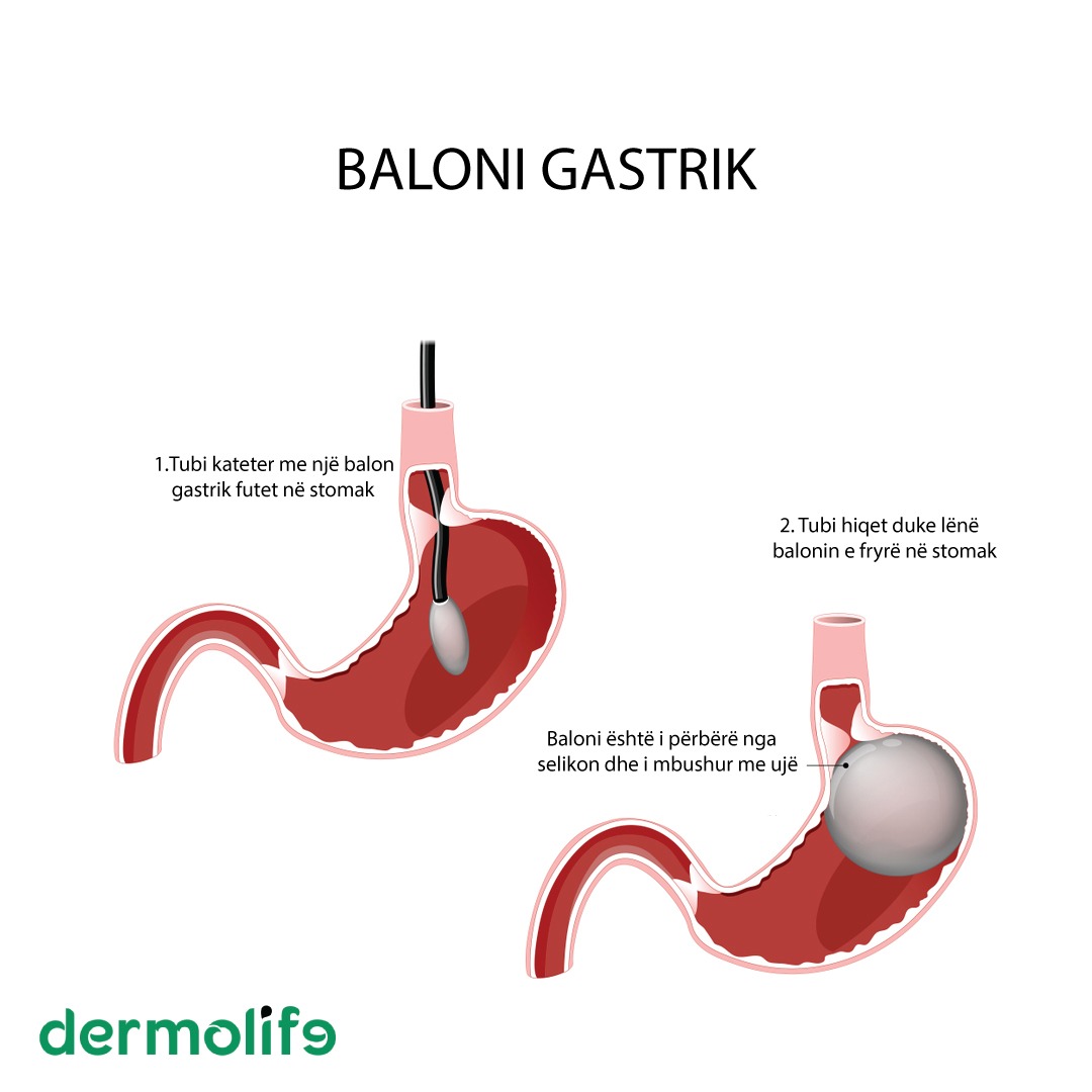 Gastric sleeve