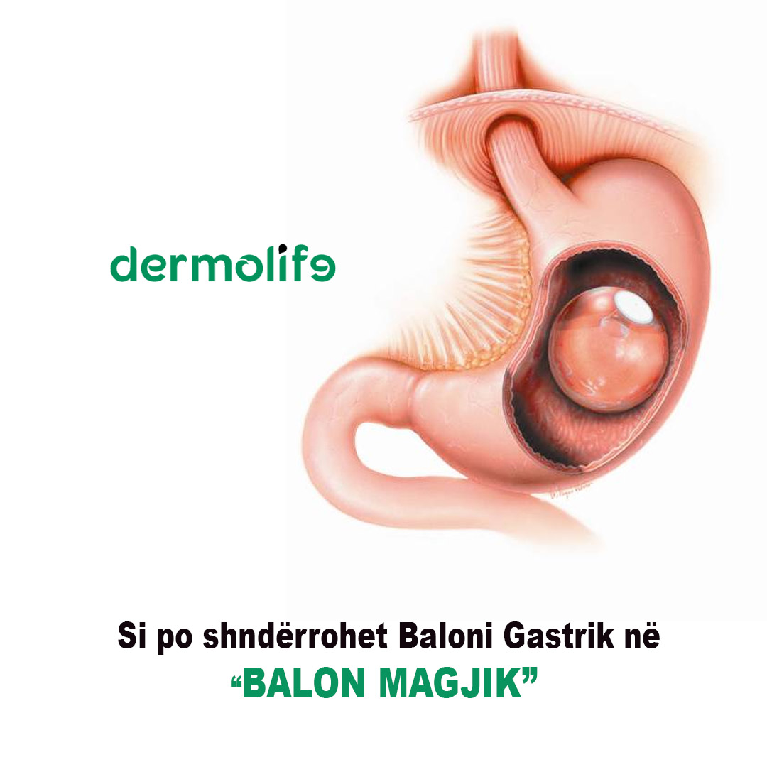 Si po shnderrohet baloni gastrik ne baloni “magjik”