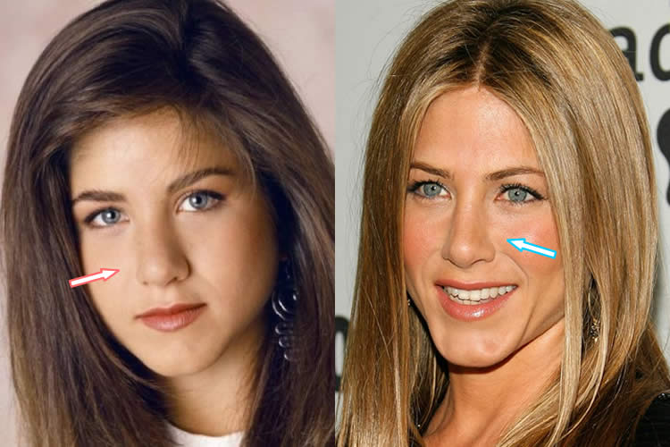 Jennifer Aniston dermolife klinik