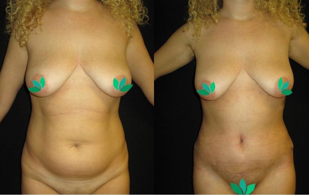 rimodelimi i barkut pamja 7 dermolife