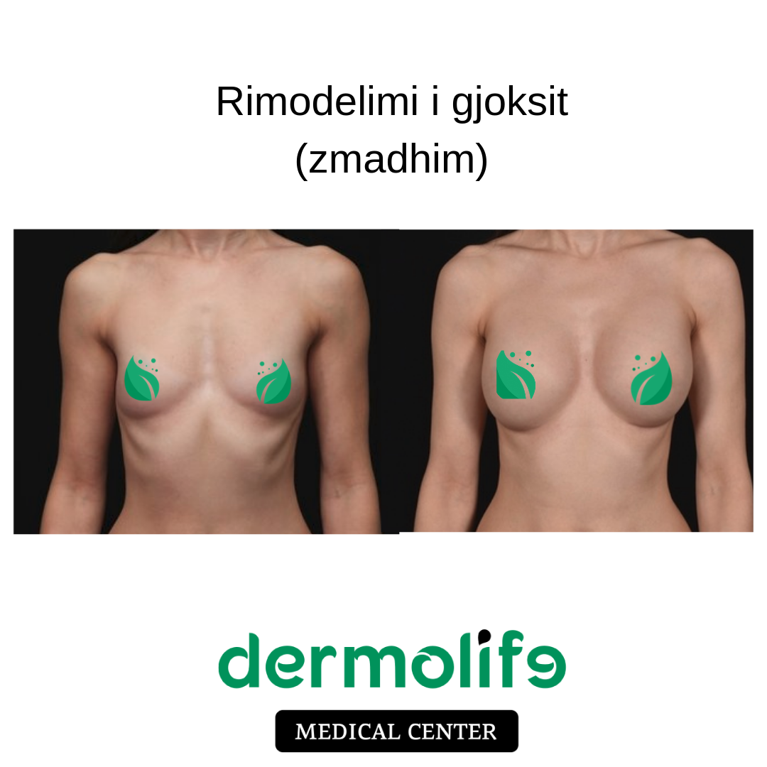zmadhimi gjoksit pamja 10 dermolife