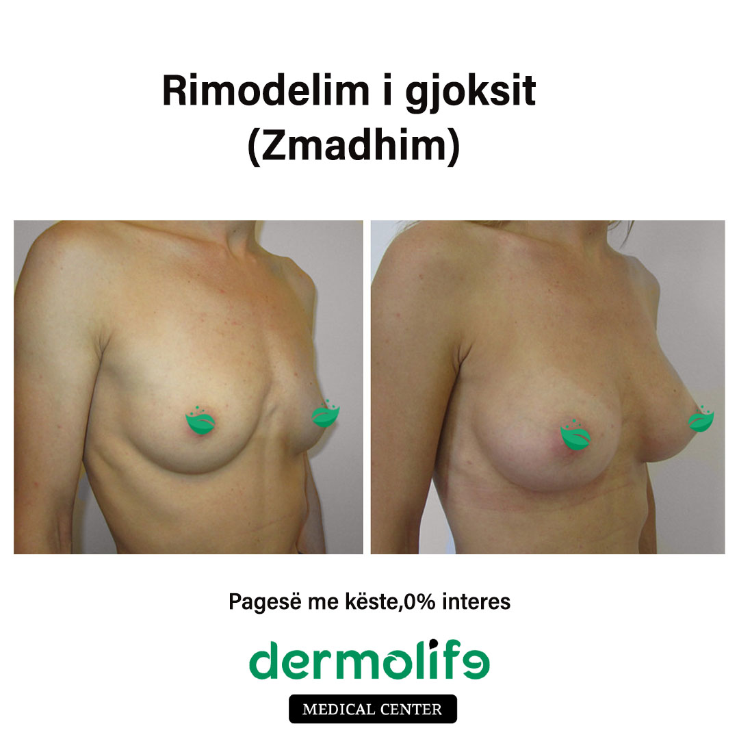 zmadhimi gjoksit pamja 8 dermolife