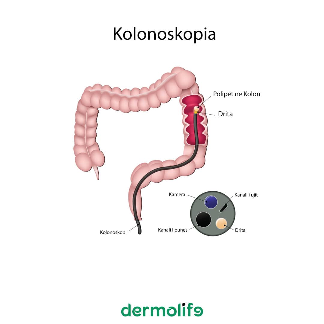 Cfare eshte kolonoskopia