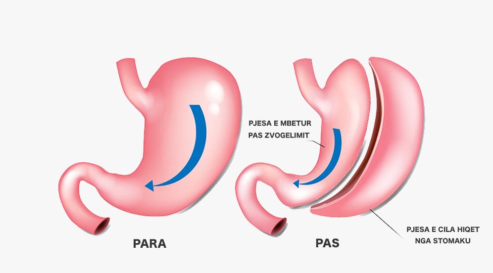 Operacioni i zvogelimit te stomakut